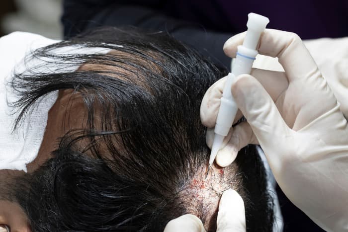 Hair Transplant London Before and After Results