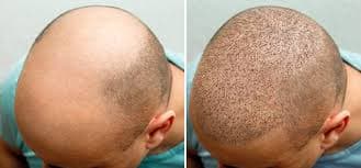 Hair Transplant Istanbul: Where Innovation Meets Experience