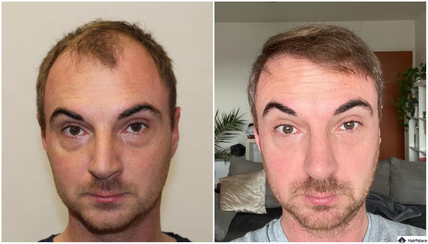 Hair Transplant London – Advanced FUE &amp; FUT Techniques Explained