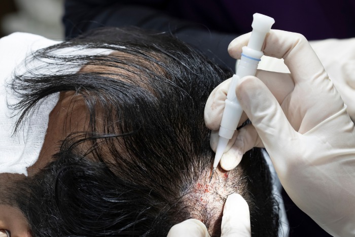Hair Transplant London Before and After Results