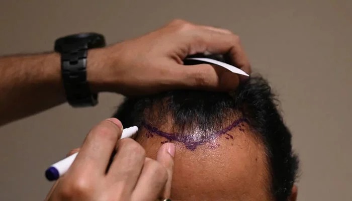 Sapphire Hair Clinic – Modern Hair Transplant Turkey Methods